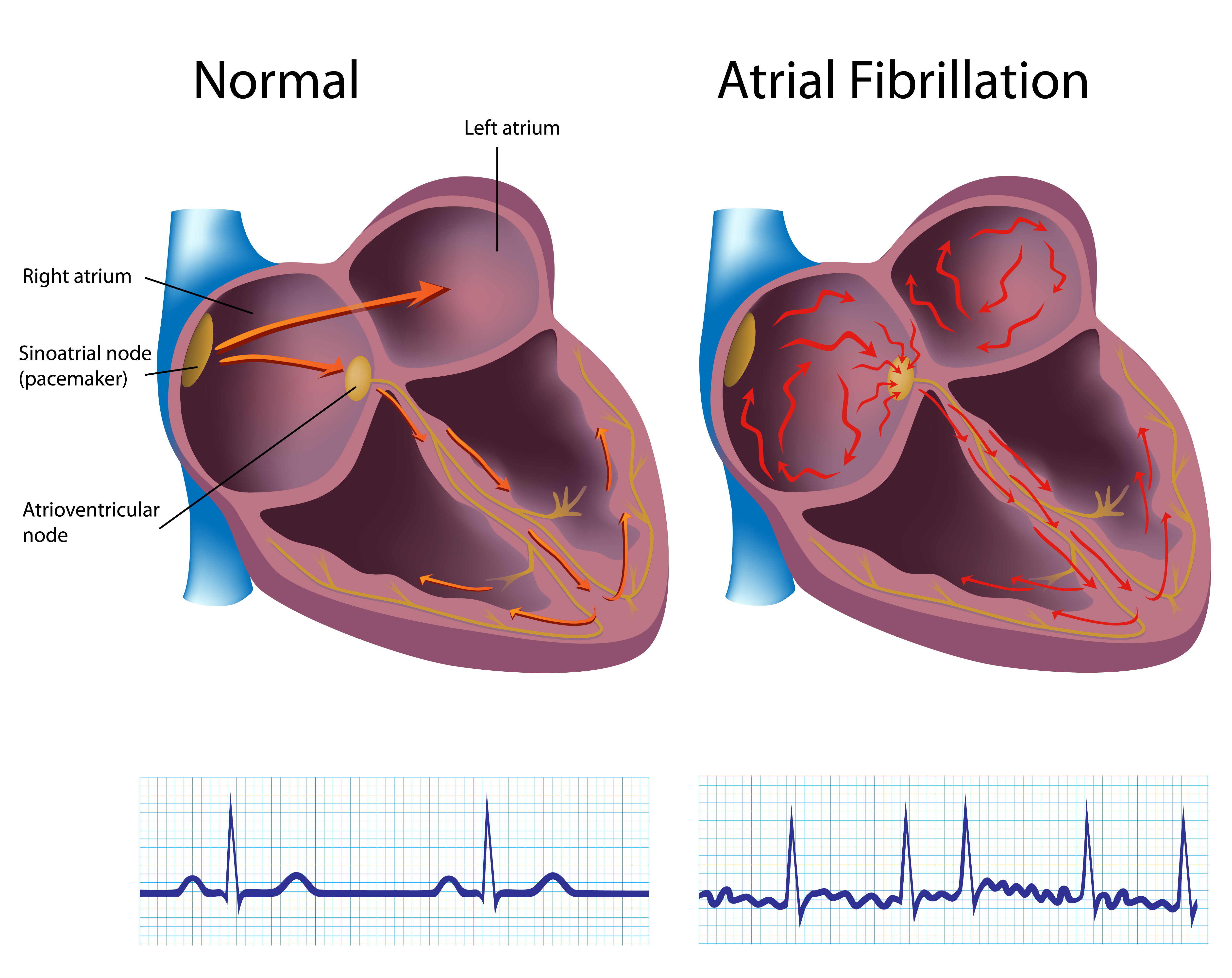 Normal heart versus a-fib heart